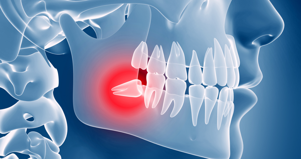 illustration of wisdom tooth